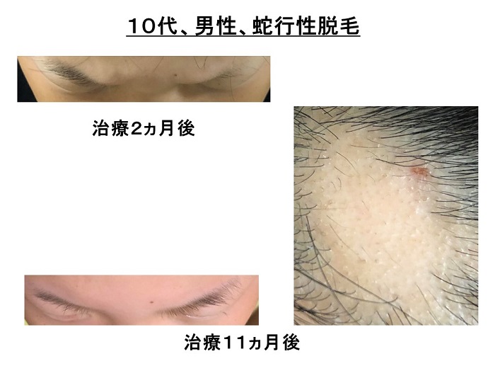 円形脱毛症　病院